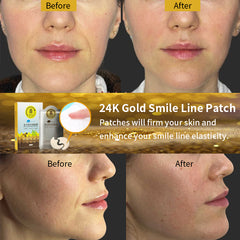 24K Gold Smile Line Patches